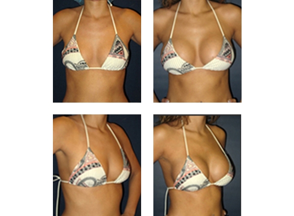 Cost Of Liposuction New Zealand 2014 Liposuction And Tummy Tuck Nyc Finance Breast Implants