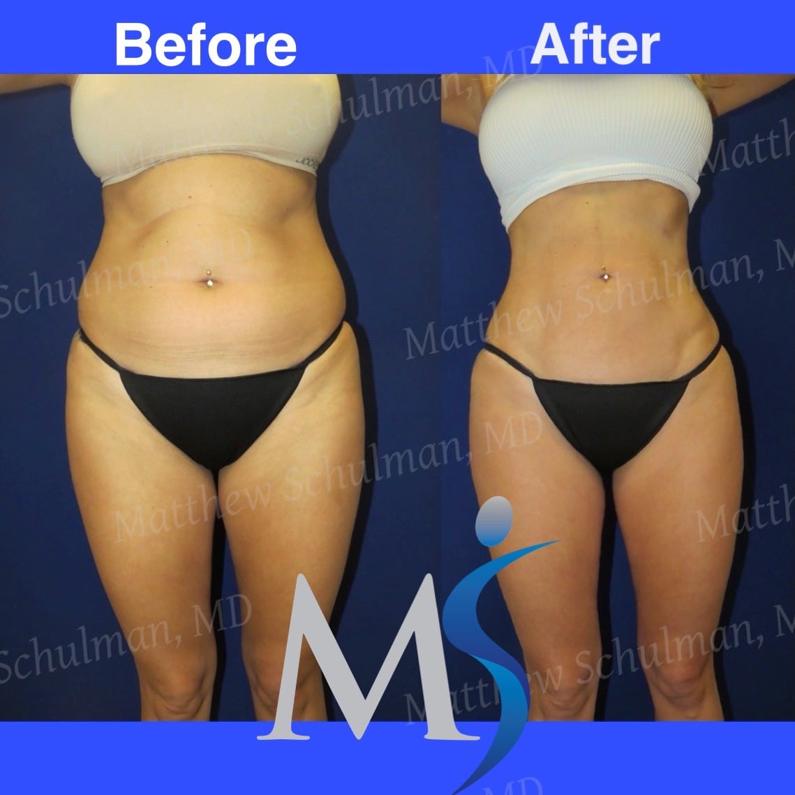 liposuction new york