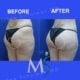 Aveli cellulite Treatment NYC Patient 5