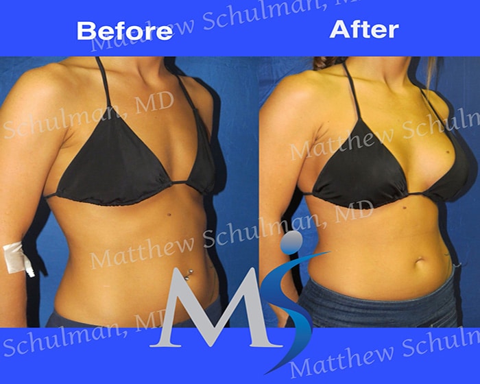 Breast Augmentation B To Full C Cup Before & After Patient Photos