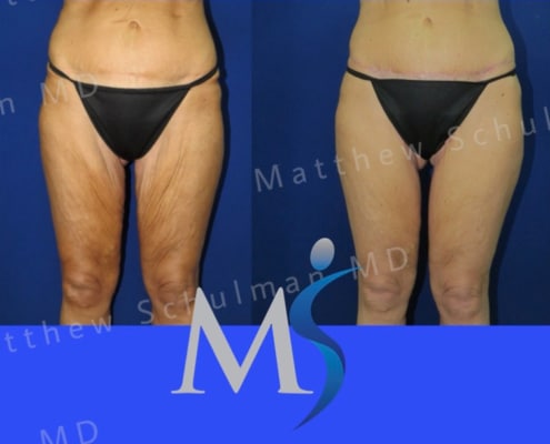 Inner thigh lift NYC