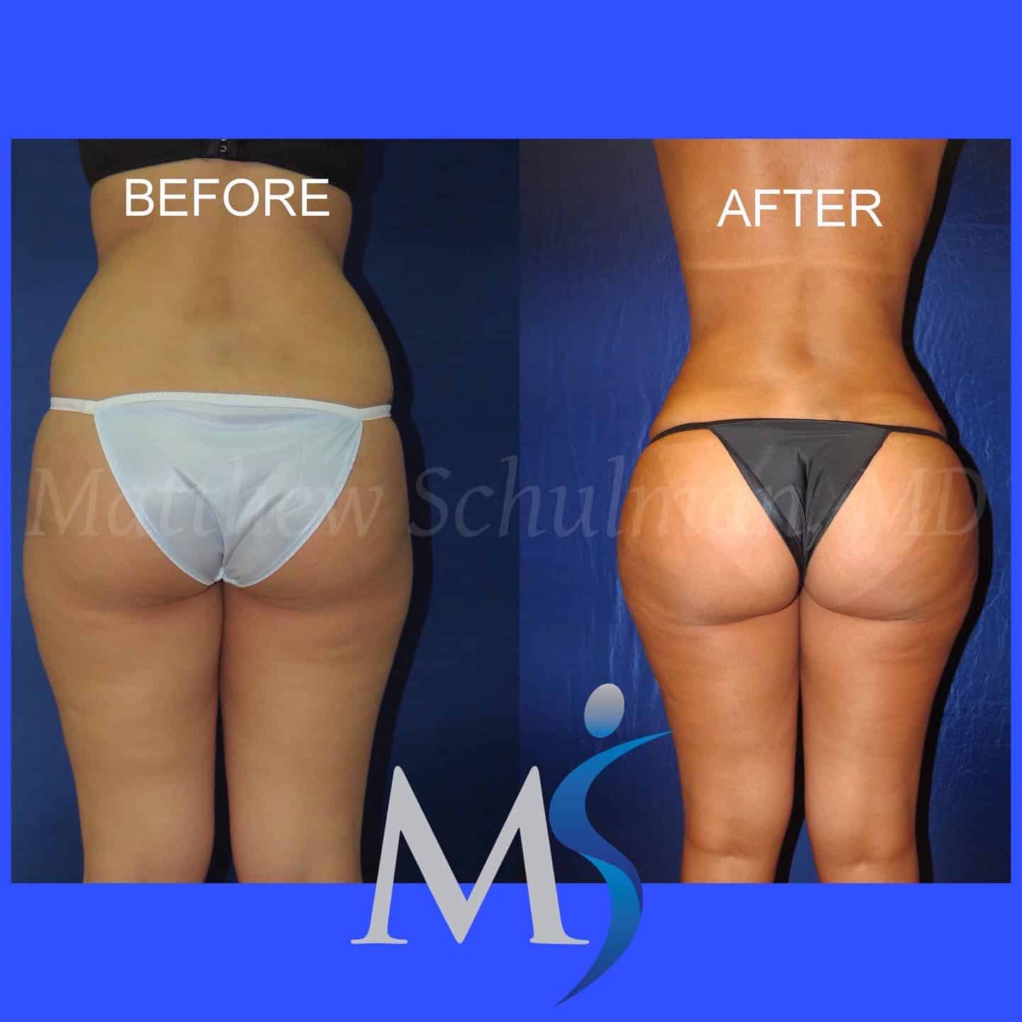 Lipo 360 Before and After: What to Expect