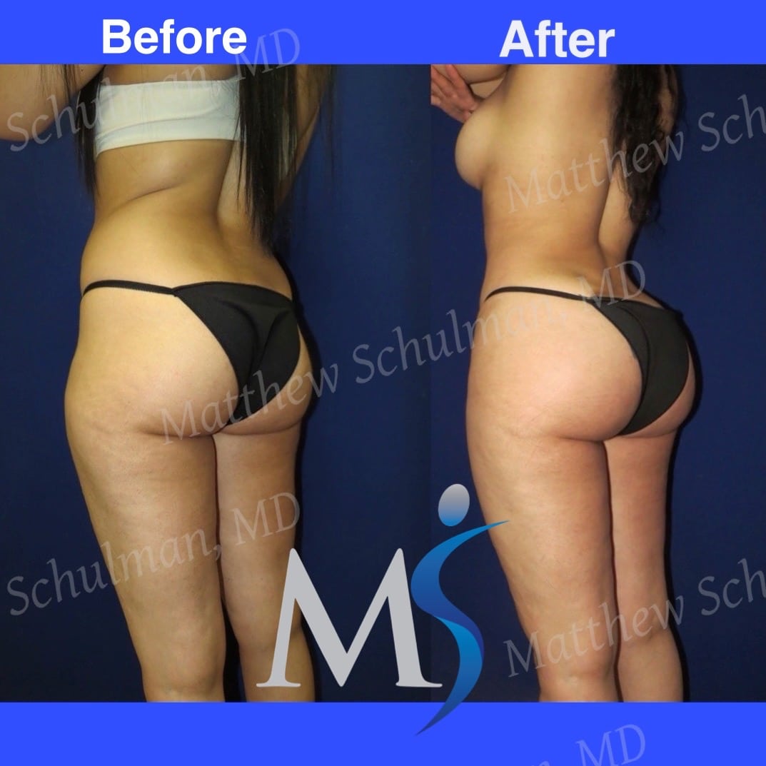 Is Liposuction Permanent? What You Need to Know - Clinic 360
