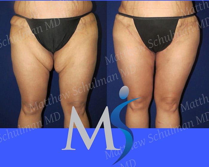 The L-Shaped Inner Thigh Lift - Explore Plastic Surgery